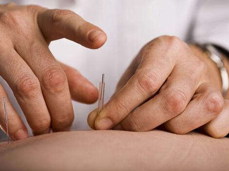 鍼を打つ鍼灸師