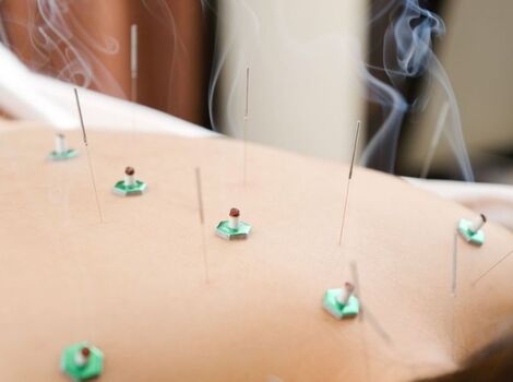 お灸と鍼の治療中