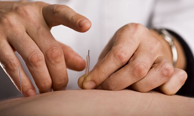 鍼を打つ鍼灸師